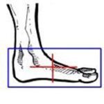 62-ixray_fuss_lateral
